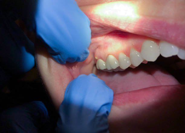 Best Emergency Dental Filling Replacement  in Pike Road, AL